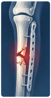 X-ray showing failed fracture fixation before revision